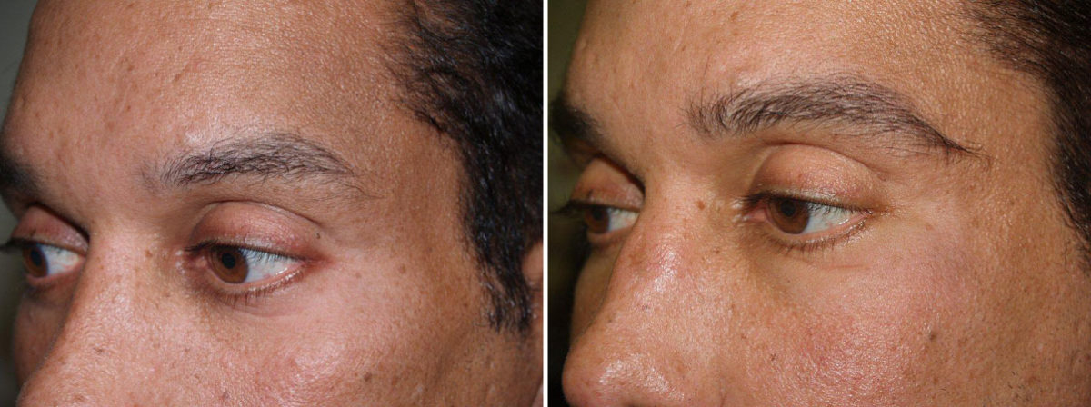 Eyebrow Hair Transplant Before and after in Miami, FL, Paciente 36126