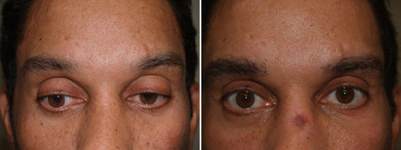 Eyebrow Hair Transplant Before and after in Miami, FL, Paciente 36126