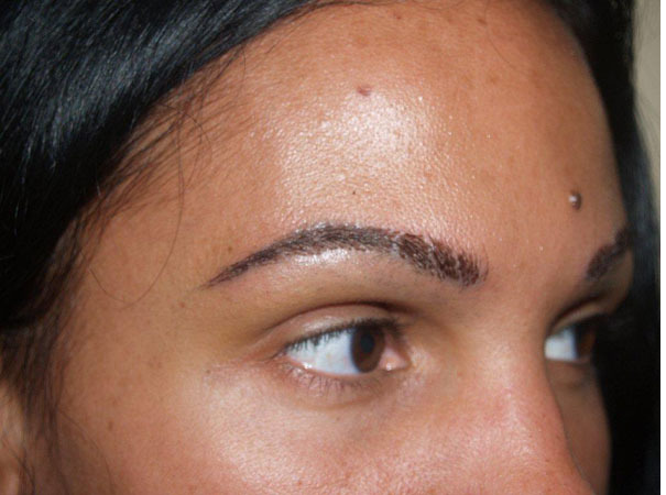 Eyebrow Hair Transplant Before and after in Miami, FL, Paciente 36133