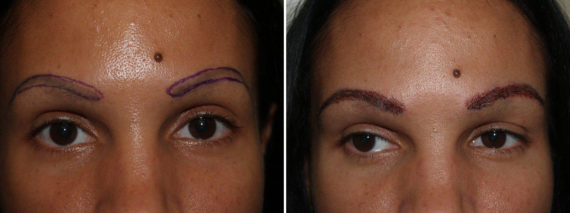 Eyebrow Hair Transplant Before and after in Miami, FL, Paciente 36133