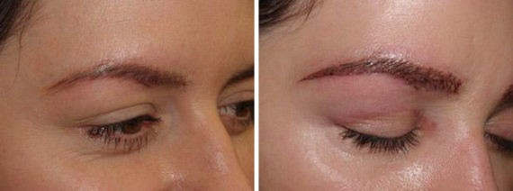 Eyebrow Hair Transplant Before and after in Miami, FL, Paciente 36567