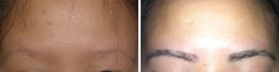 Eyebrow Hair Transplant Before and after in Miami, FL, Paciente 36588