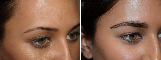 Eyebrow Hair Transplant Before and after in Miami, FL, Paciente 36615