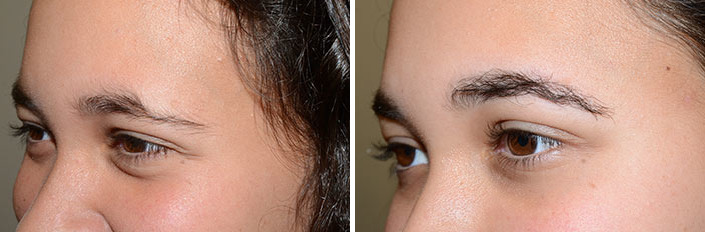 Eyebrow Hair Transplant Before and after in Miami, FL, Paciente 36647