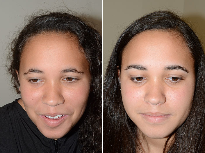 Eyebrow Before and after in Miami, FL, Paciente 36647