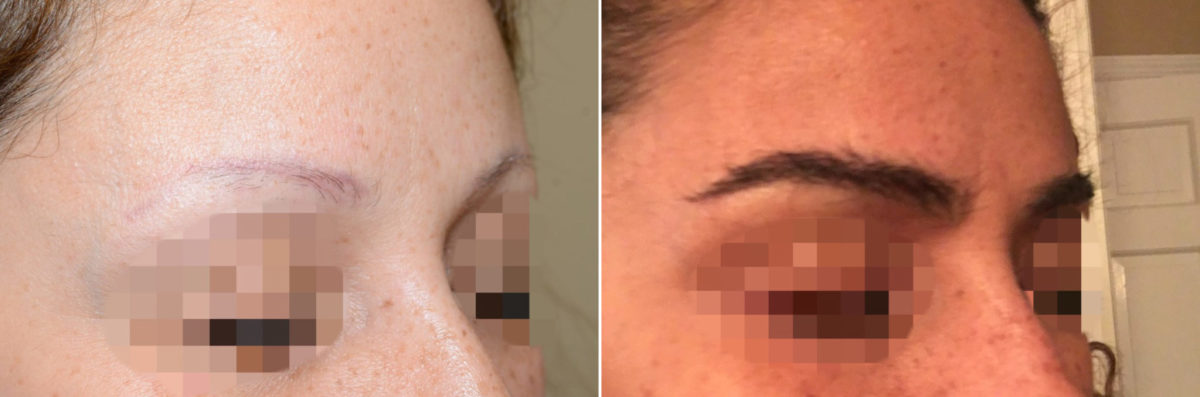 Eyebrow Before and after in Miami, FL, Paciente 36687
