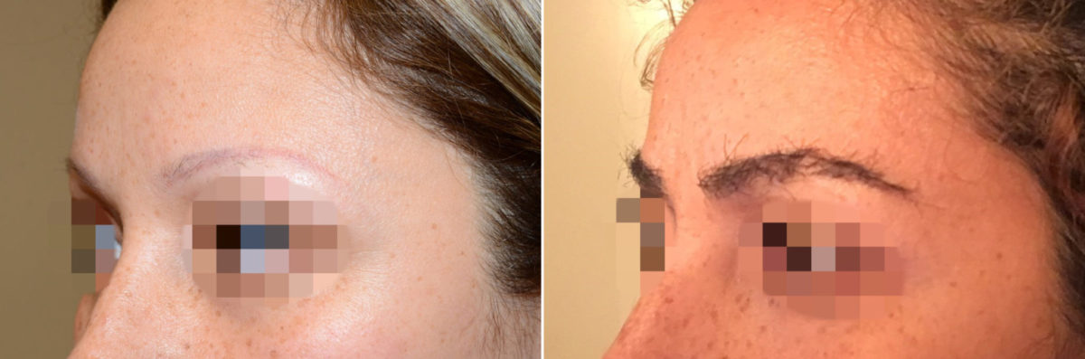 Eyebrow Hair Transplant Before and after in Miami, FL, Paciente 36687