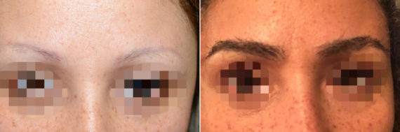 Eyebrow Hair Transplant Before and after in Miami, FL, Paciente 36687