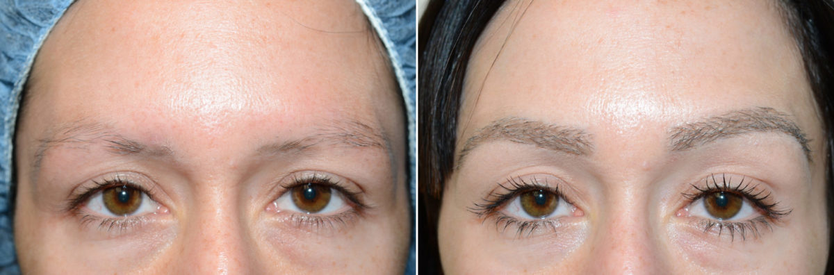 Eyebrow Before and after in Miami, FL, Paciente 36694