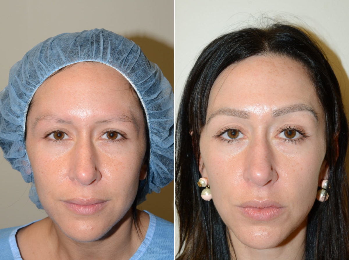 Eyebrow Before and after in Miami, FL, Paciente 36694