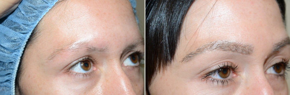 Eyebrow Hair Transplant Before and after in Miami, FL, Paciente 36694