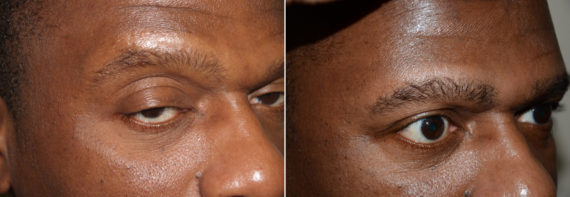 Eyebrow Hair Transplant Before and after in Miami, FL, Paciente 36713