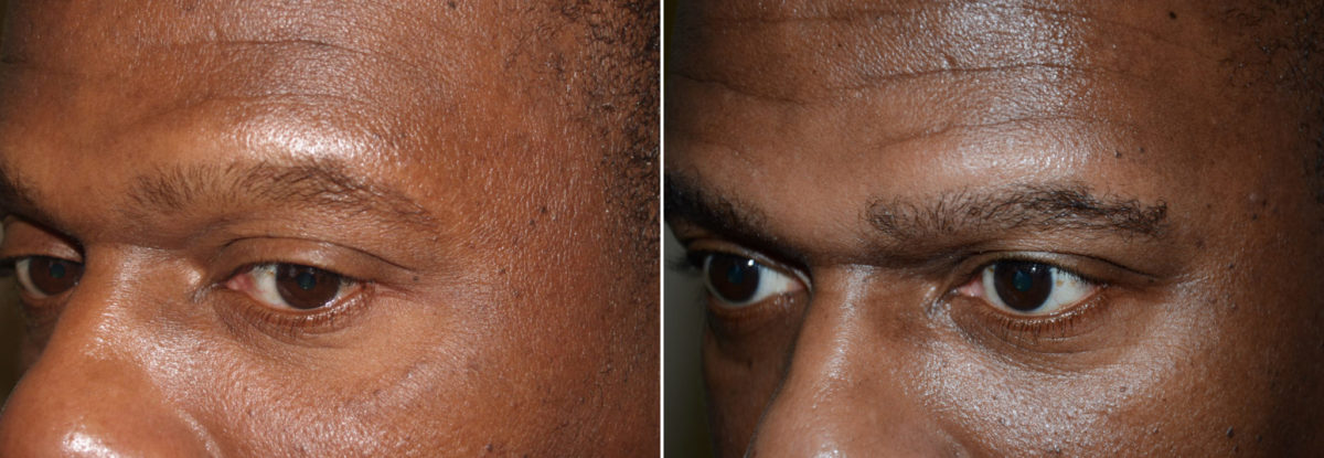 Eyebrow Hair Transplant Before and after in Miami, FL, Paciente 36713
