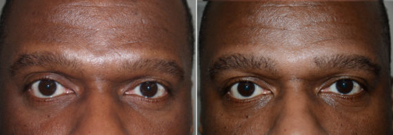 Eyebrow Before and after in Miami, FL, Paciente 36713