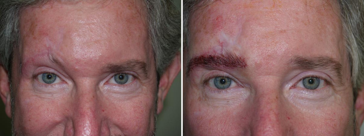 Special Cases Before and after in Miami, FL, Paciente 40939
