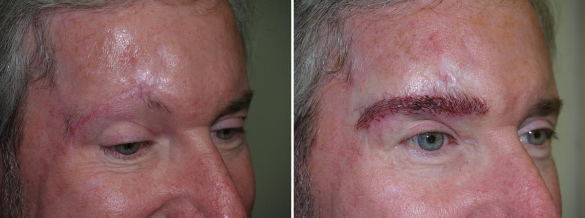 Special Cases Before and after in Miami, FL, Paciente 40939