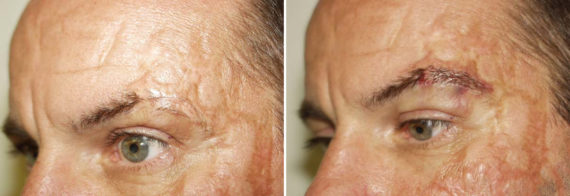 Special Cases Before and after in Miami, FL, Paciente 40949