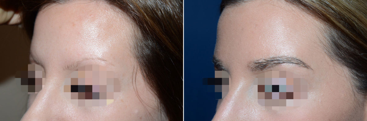 Eyebrow Before and after in Miami, FL, Paciente 47669