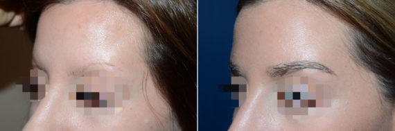 Eyebrow Before and after in Miami, FL, Paciente 47669