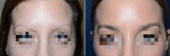 Eyebrow Hair Transplant Before and after in Miami, FL, Paciente 47669