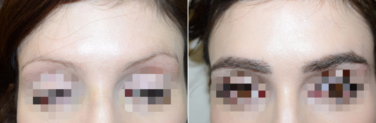 Eyebrow Before and after in , , Paciente 48577