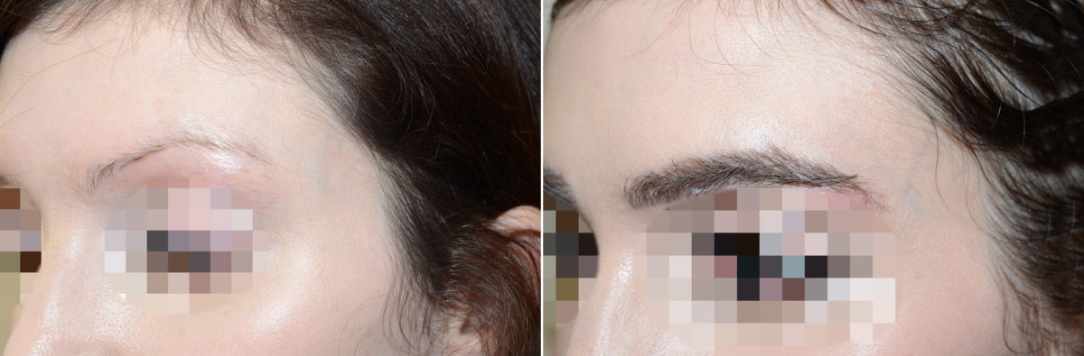 Eyebrow Hair Transplant Before and after in , , Paciente 48577