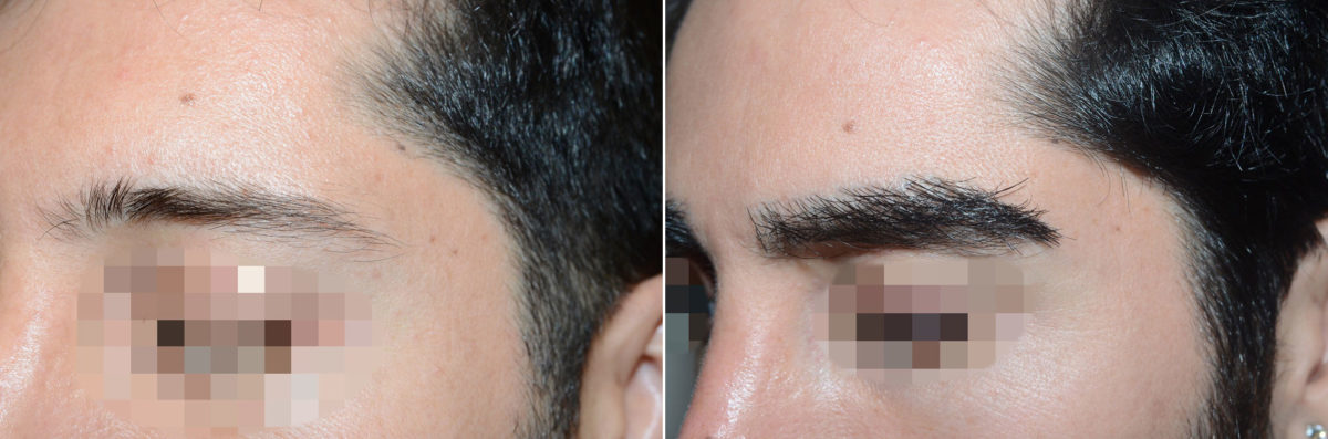 Eyebrow Hair Transplant Before and after in Miami, FL, Paciente 57638