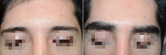 Eyebrow Hair Transplant Before and after in Miami, FL, Paciente 57638