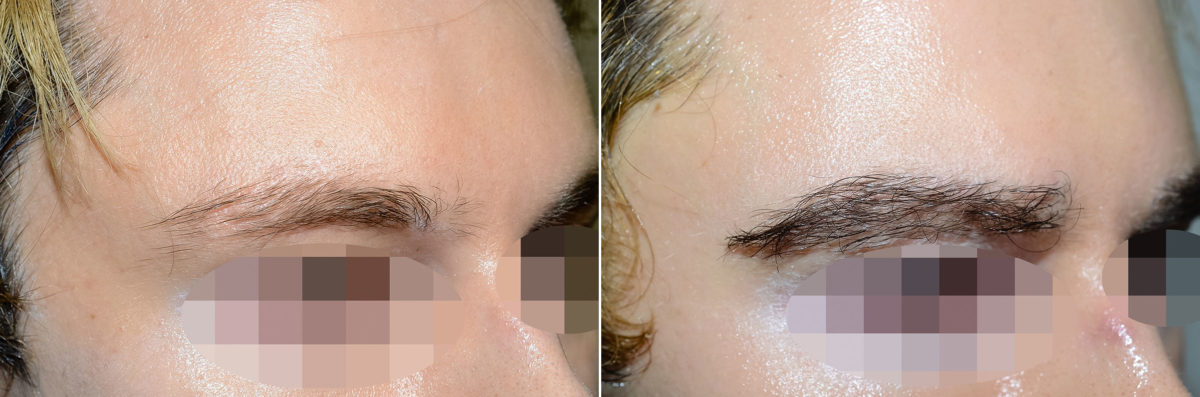 Eyebrow Hair Transplant Before and after in Miami, FL, Paciente 57803