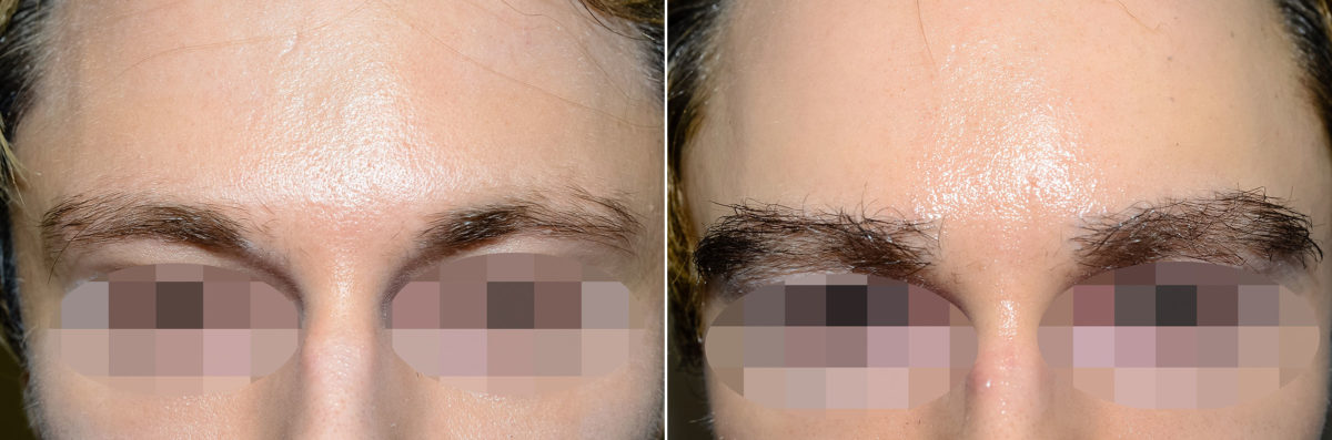 Eyebrow Hair Transplant Before and after in Miami, FL, Paciente 57803