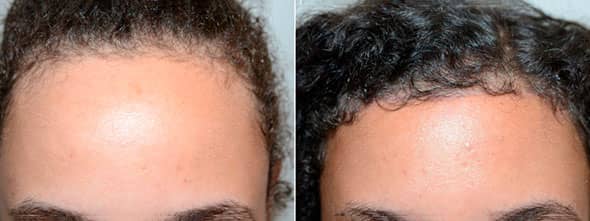 22 yo female underwent hairline lowering/forehead reduction surgery that was able to lower her hairline by 1 1/4 inches.