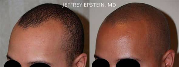 Before and eight months after one procedure of 1,600 FUE grafts to restore fron to temporal recessions.