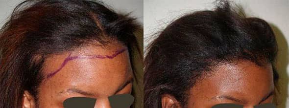 Before and after one procedure of 1,900 grafts. Hair Transplants for Women