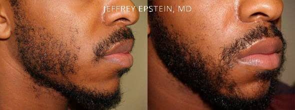 Before and after 450 grafts to goatee region
