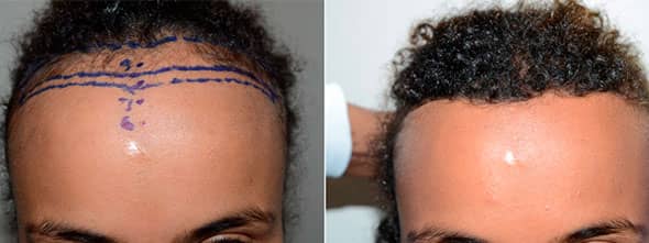 20 year old African female was able to achieve over one inch of lowering of the hairline in a single stage forehead reduction surgery.