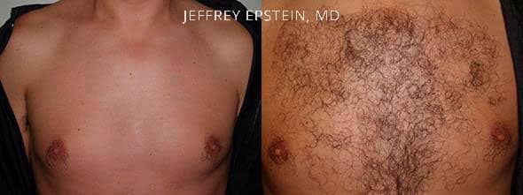 Before and after one procedure of 1,900 grafts to the chest.