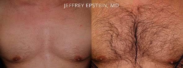 Before and after one procedure of 2,200 grafts to the chest.