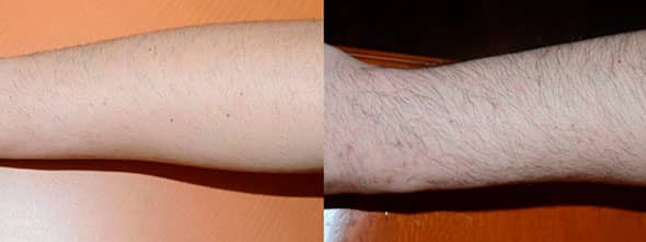 Before and one year after 300 grafts to each forearm. The grafts came from the scalp by FUE technique.