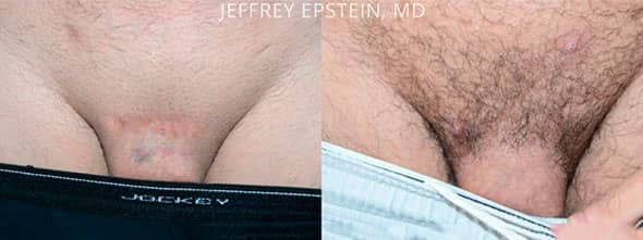 Patient after 300 hair grafts to conceal scar from prior penile elongation surgery.