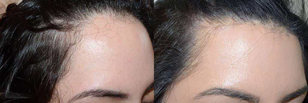 Before and just two weeks after hairline lowering / forehead reduction surgery