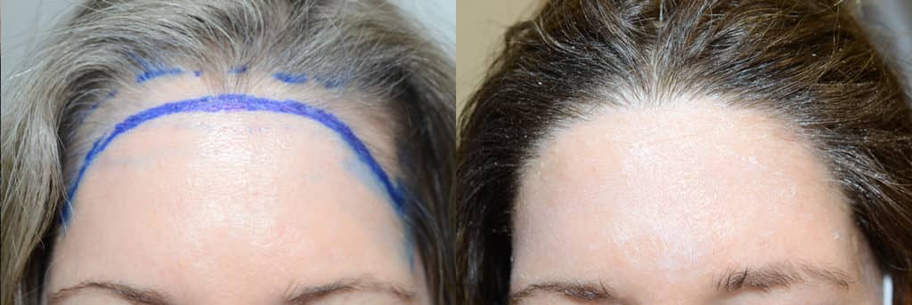 Hair Transplantation can be an effective alternative to the hairline lowering surgery, particularly when primarily rounding out is desired-  here is a patient before and after one procedure of 2,800 grafts
