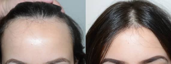 Before and after hairline lowering/forehead shortening surgery, also called the surgical hairline advancement for the lowering of the hairline by 3 cm front view