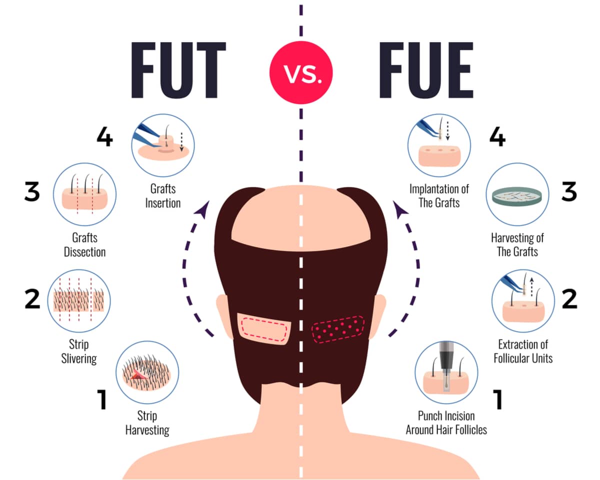  A surgeon is likely to use one of two restoration techniques during a hair transplant: FUT or FUE