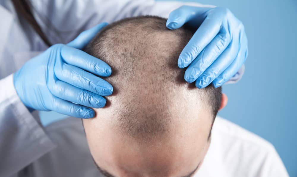 How Much Do Hair Transplants Cost? | Hair Transplant Cost Guide
