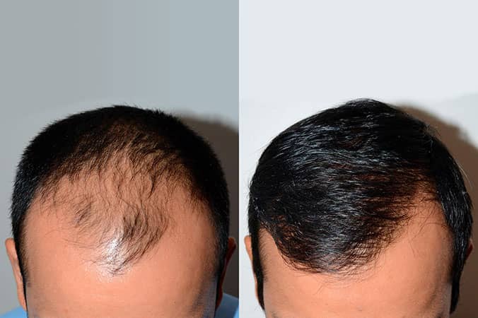 Before and After  2,050 FUE Grafts