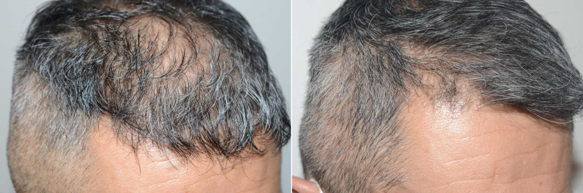 Hair Transplants for Men Before and after in Miami, FL, Paciente 121062