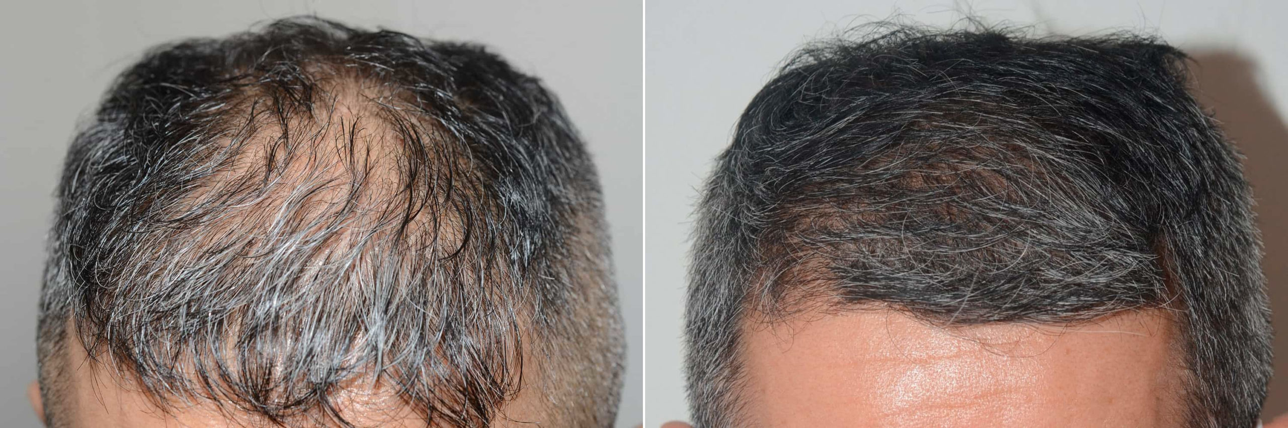 Hair Transplants for Men photos | Miami, FL | Patient121062
