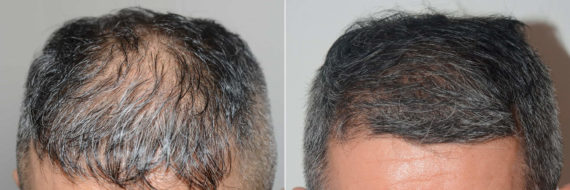 Trasplante de Pelo en Hombres Before and after in Miami, FL, Paciente 121075
