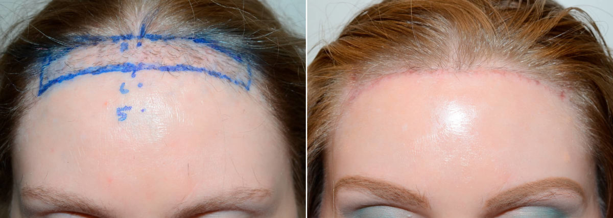 Hairline Advancement Before and after in Miami, FL, Paciente 58650