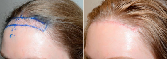 Forehead Reduction Surgery Before and after in Miami, FL, Paciente 58650